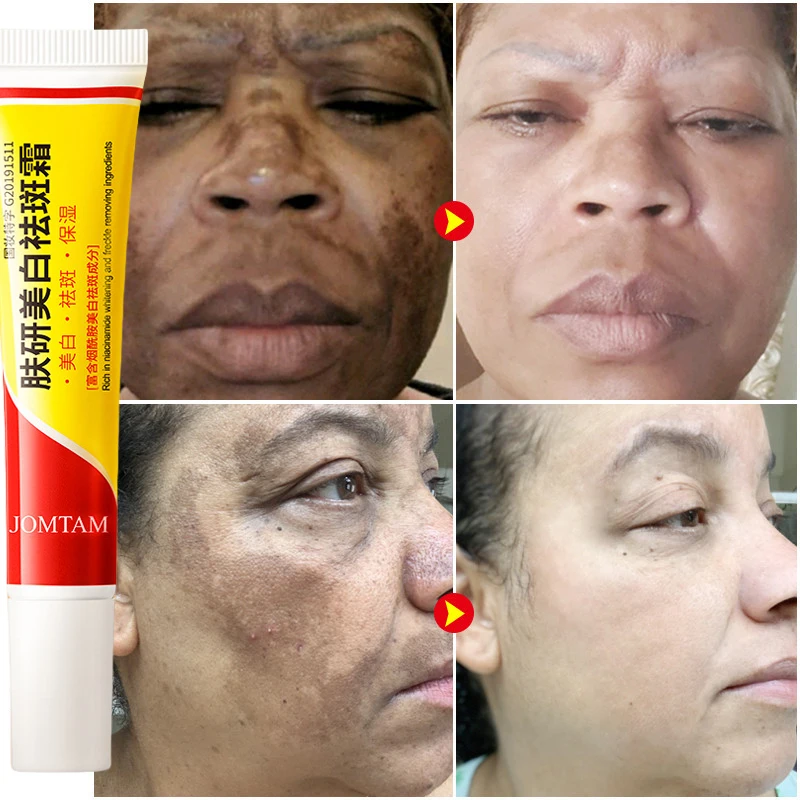 Whitening Freckle Cream Face B - Skincare Glad2Glow avis et prix