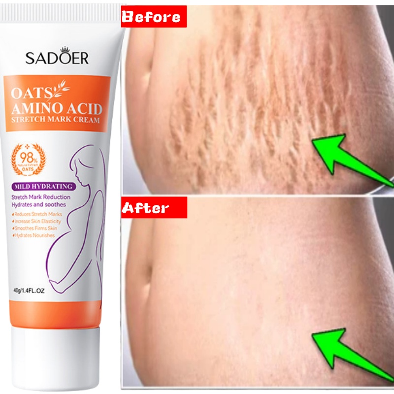 Stretch Marks Permanent Remova - Skincare Oat avis et prix