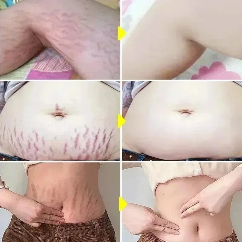 Stretch Marks Permanent Remova - Skincare Oat avis et prix