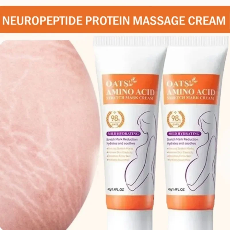 Stretch Marks Permanent Remova - Skincare Oat avis et prix