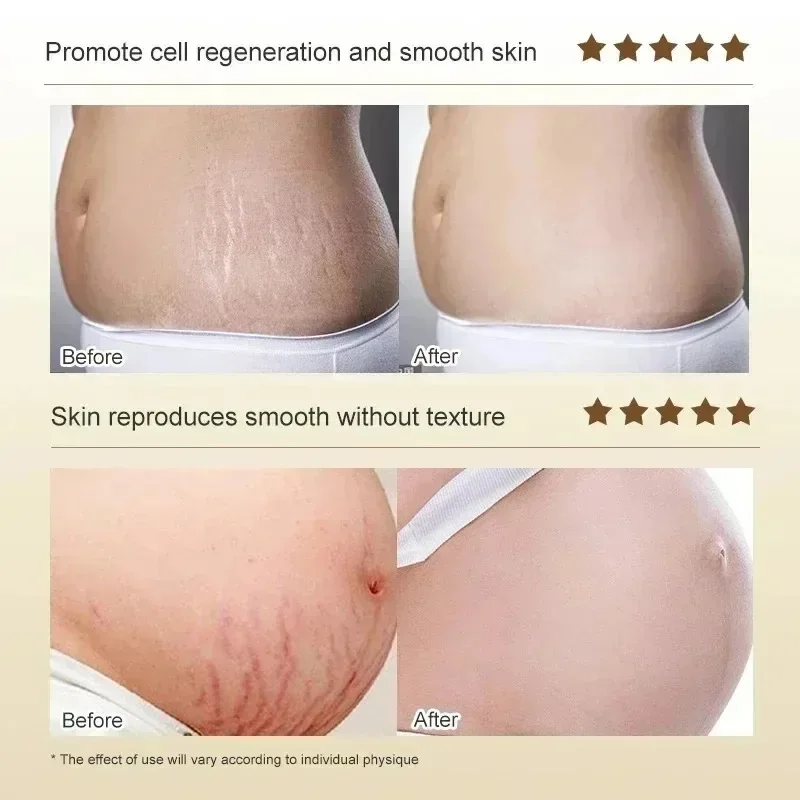 Stretch Marks Permanent Remova - Skincare Oat avis et prix