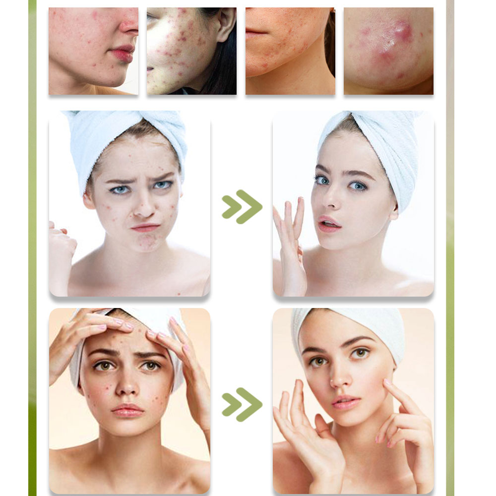 KStims Natural Acne Treatment  - Tea Tree Spot Treatment avis et prix